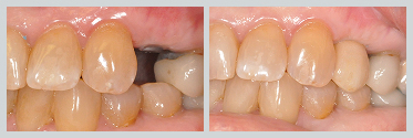 Before and After Dental Implants 16