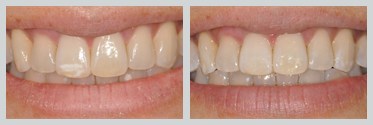 Before and After Icon Resin Infiltration