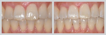 Before and After Icon Resin Infiltration