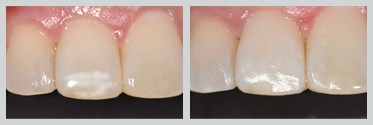 Before and After Icon Resin Infiltration