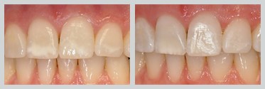 Before and After Icon Resin Infiltration