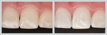 Before and After Icon Resin Infiltration