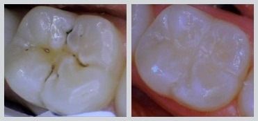 Before and After Dental Sealants Case 17