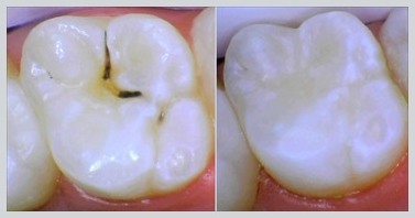 Before and After Dental Sealants Case 18