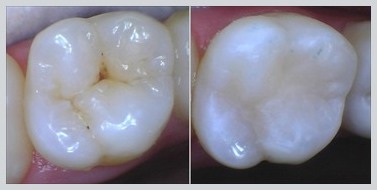 Before and After Dental Sealants Case 19