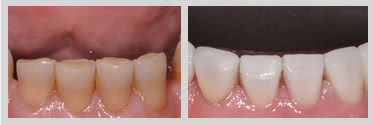 Before and After Smile Makeover