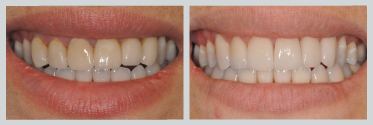 Before and After Smile Makeover