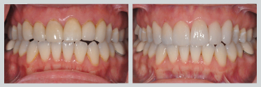 Before and After Smile Makeover