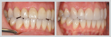 Before and After Smile Makeover