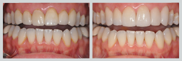 Before and After Smile Makeover