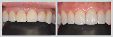 Before and After Smile Makeover