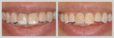Before and After Smile Makeover 19