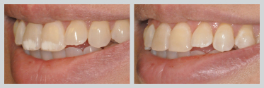 Before and After Smile Makeover 20