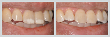Before and After Smile Makeover 21