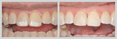 Before and After Smile Makeover 22